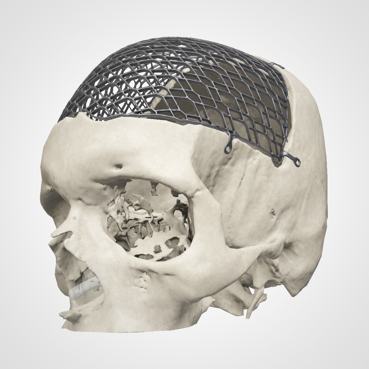 A skull with supporting net