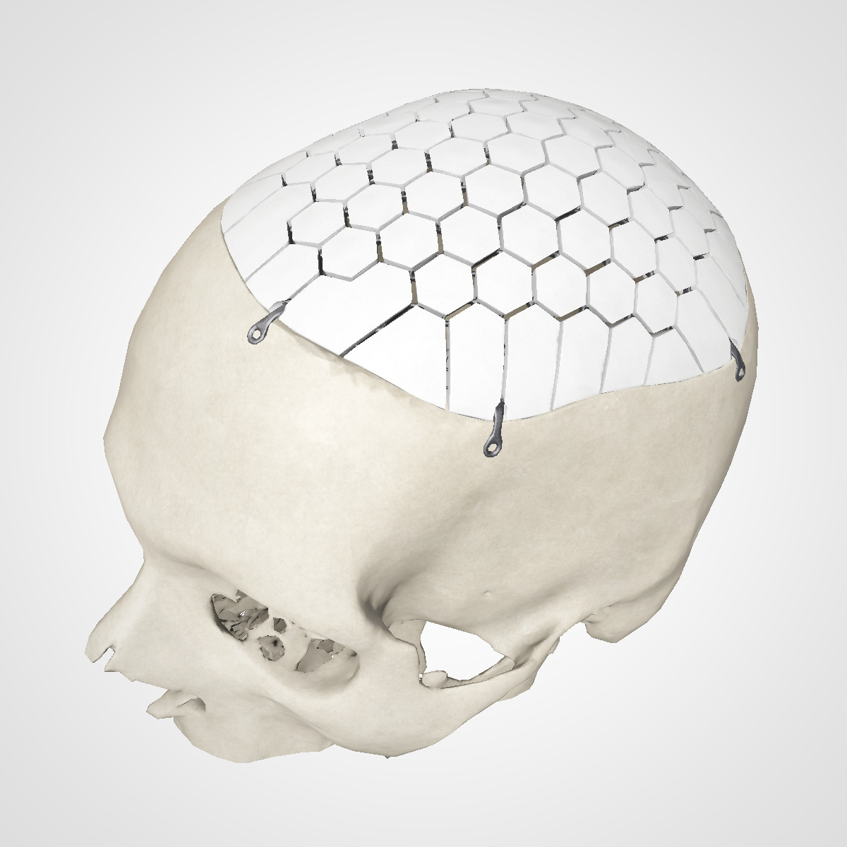 A skull with complete skull implant